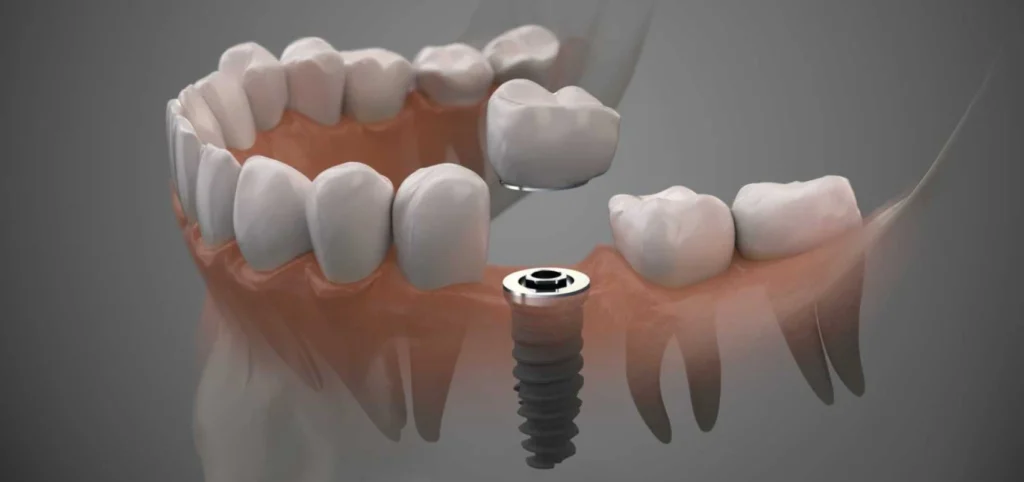 implants dentaires montauban Implants dentaires Chirurgiens-dentistes à Montauban