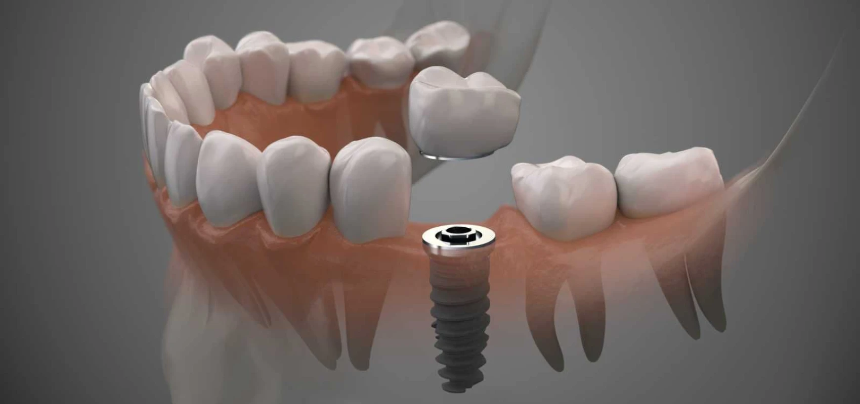 implants dentaires montauban Implants dentaires Chirurgiens-dentistes à Montauban