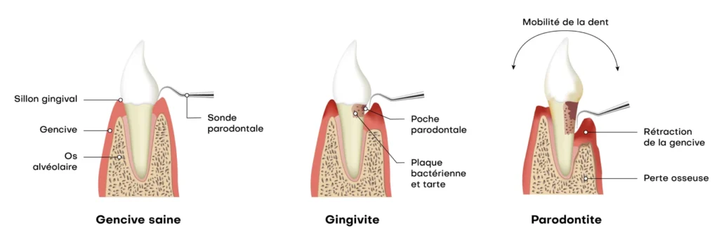 soin gencives parodontologie montauban Parodontite : la maladie des gencives Chirurgiens-dentistes à Montauban