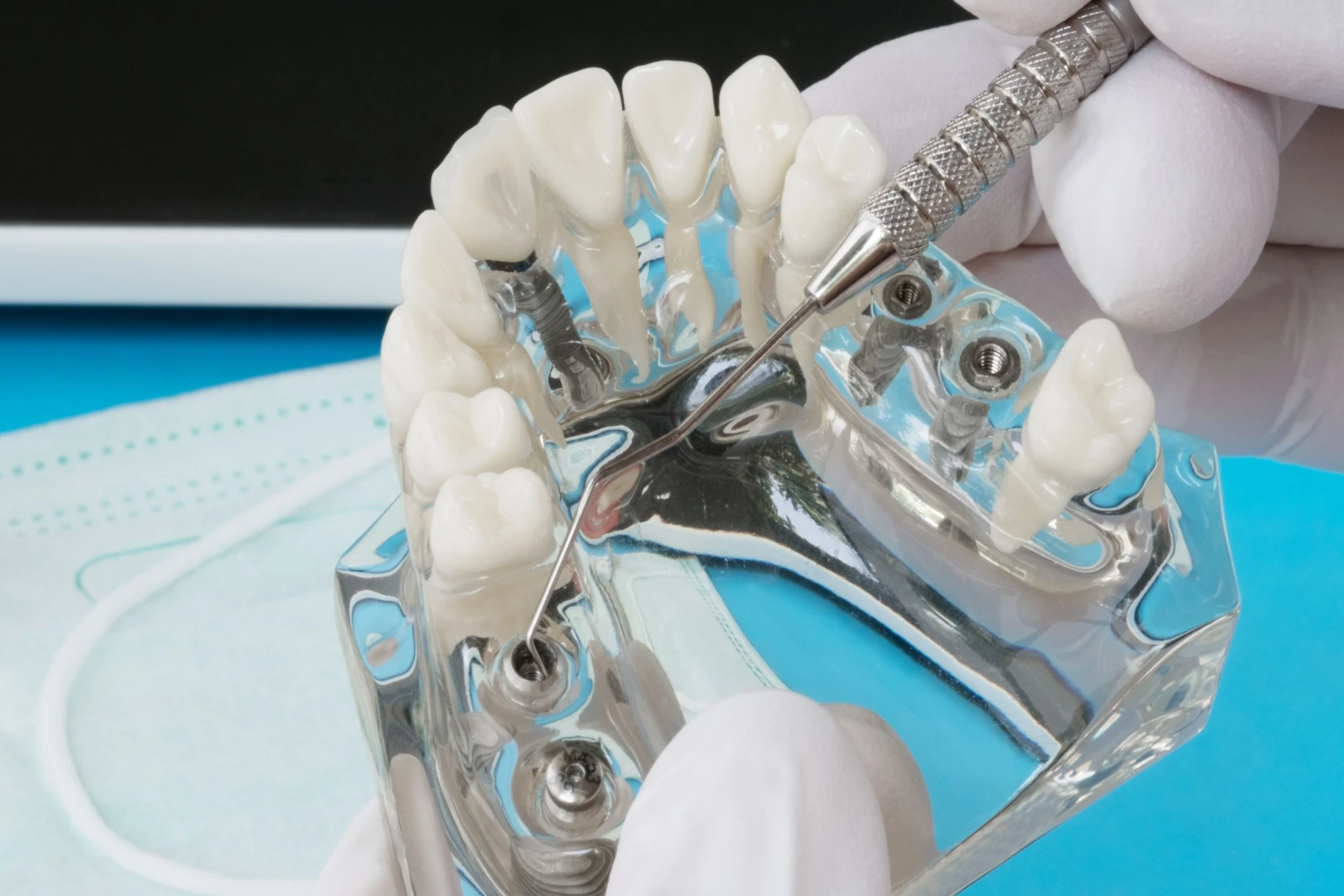 chirurgie-guidee-dentaire-implants-dentiste-montauban